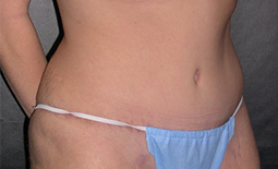 Tummy Tuck Before and After Pictures Plano, TX