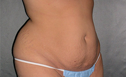 Tummy Tuck Before and After Pictures Plano, TX