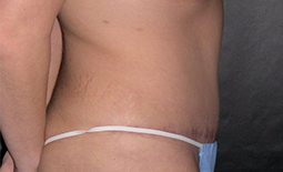 Tummy Tuck Before and After Pictures Plano, TX