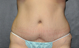 Tummy Tuck Before and After Pictures Plano, TX