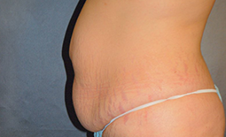 Tummy Tuck Before and After Pictures Plano, TX