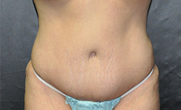 Tummy Tuck Before and After Pictures Plano, TX