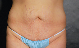 Tummy Tuck Before and After Pictures Plano, TX