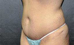 Tummy Tuck Before and After Pictures Plano, TX