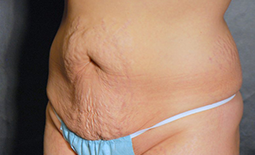 Tummy Tuck Before and After Pictures Plano, TX