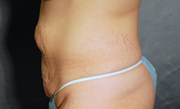 Tummy Tuck Before and After Pictures Plano, TX