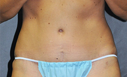 Tummy Tuck Before and After Pictures Plano, TX