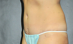 Tummy Tuck Before and After Pictures Plano, TX