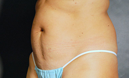 Tummy Tuck Before and After Pictures Plano, TX