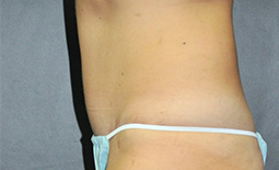 Tummy Tuck Before and After Pictures Plano, TX