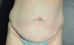 Tummy Tuck Before and After Pictures Plano, TX