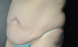 Tummy Tuck Before and After Pictures Plano, TX