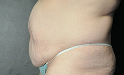 Tummy Tuck Before and After Pictures Plano, TX