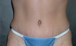 Tummy Tuck Before and After Pictures Plano, TX