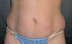 Tummy Tuck Before and After Pictures Plano, TX