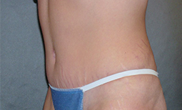 Tummy Tuck Before and After Pictures Plano, TX