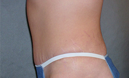 Tummy Tuck Before and After Pictures Plano, TX