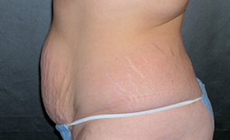 Tummy Tuck Before and After Pictures Plano, TX