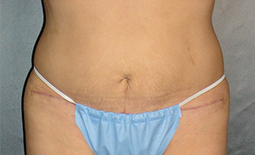 Tummy Tuck Before and After Pictures Plano, TX