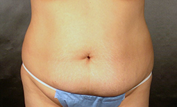 Tummy Tuck Before and After Pictures Plano, TX