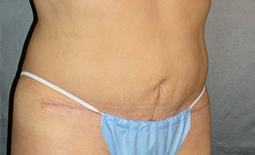 Tummy Tuck Before and After Pictures Plano, TX