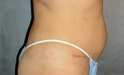 Tummy Tuck Before and After Pictures Plano, TX