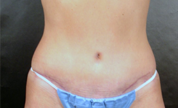 Tummy Tuck Before and After Pictures Plano, TX