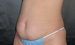 Tummy Tuck Before and After Pictures Plano, TX