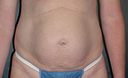 Tummy Tuck Before and After Pictures Plano, TX