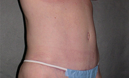 Tummy Tuck Before and After Pictures Plano, TX