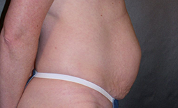 Tummy Tuck Before and After Pictures Plano, TX