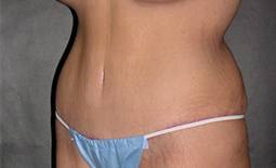 Tummy Tuck Before and After Pictures Plano, TX