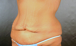 Tummy Tuck Before and After Pictures Plano, TX