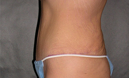 Tummy Tuck Before and After Pictures Plano, TX