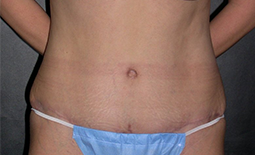 Tummy Tuck Before and After Pictures Plano, TX