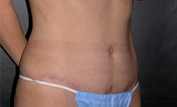 Tummy Tuck Before and After Pictures Plano, TX