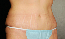 Tummy Tuck Before and After Pictures Plano, TX