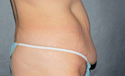 Tummy Tuck Before and After Pictures Plano, TX