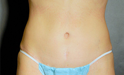 Tummy Tuck Before and After Pictures Plano, TX