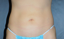 Tummy Tuck Before and After Pictures Plano, TX