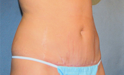 Tummy Tuck Before and After Pictures Plano, TX