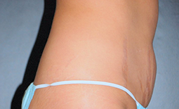 Tummy Tuck Before and After Pictures Plano, TX