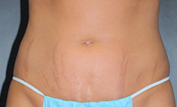 Tummy Tuck Before and After Pictures Plano, TX