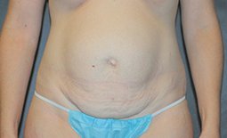 Tummy Tuck Before and After Pictures Plano, TX