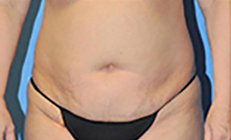 Tummy Tuck Before and After Pictures Plano, TX