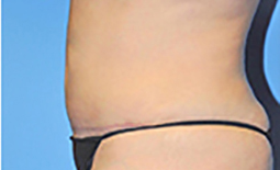 Tummy Tuck Before and After Pictures Plano, TX