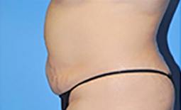 Tummy Tuck Before and After Pictures Plano, TX