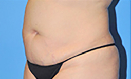 Tummy Tuck Before and After Pictures Plano, TX