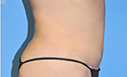 Tummy Tuck Before and After Pictures Plano, TX