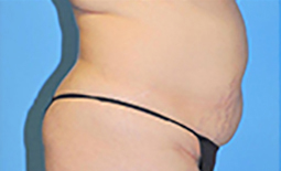 Tummy Tuck Before and After Pictures Plano, TX